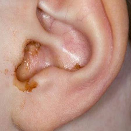 Why Is My Earwax Wet? Causes, Ear Wax Types, and When to Worry 2026