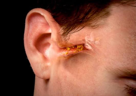 Why Do We Have Ear Wax? The Real Reason Your Body Makes It 2026