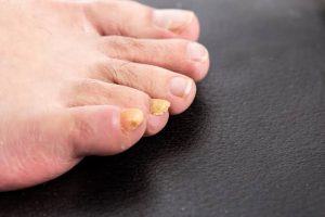 Why Do Toenails Turn Yellow? Causes and What to Do 2026