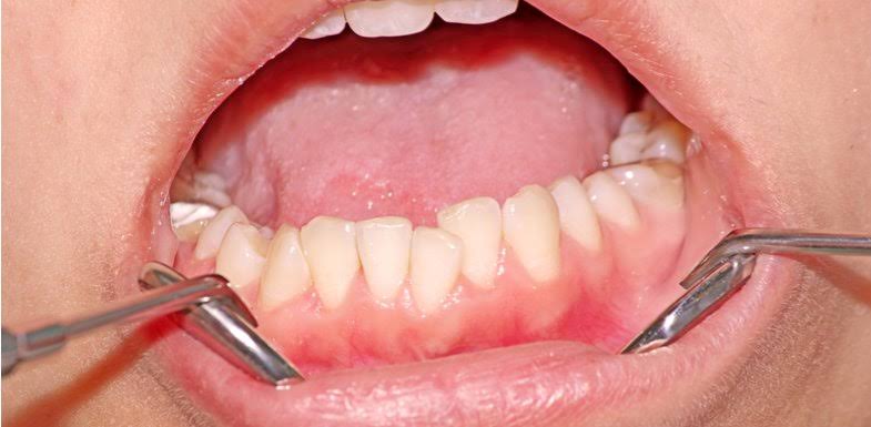 Why Do My Bottom Teeth Hurt All of a Sudden? Causes 2026