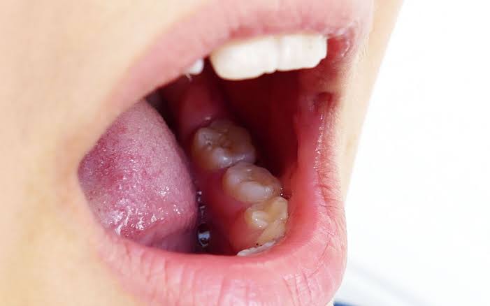 Why Does My Gum Hurt in One Spot in the Back? Causes 2026