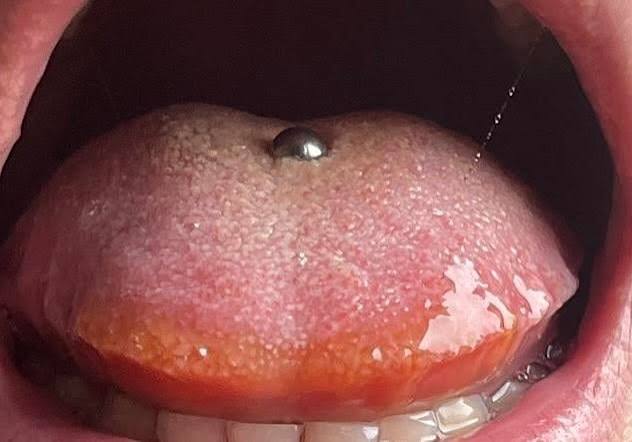 Why Is My Tongue Orange? Causes & When to Worry 2026