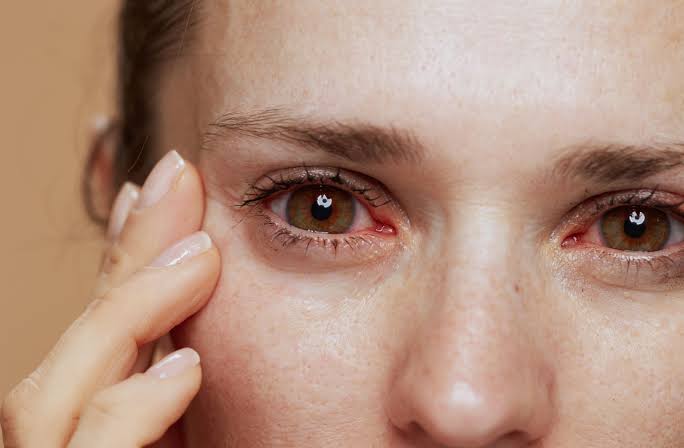 Why Is My Eye Burning? Causes & Fast Relief 2026