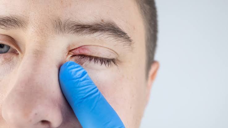 Why Is the Corner of My Eye Itchy? Causes and What to Do 2026