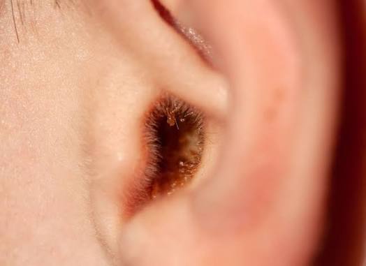 Why Is My Earwax Wet? Causes, Ear Wax Types, and When to Worry 2026