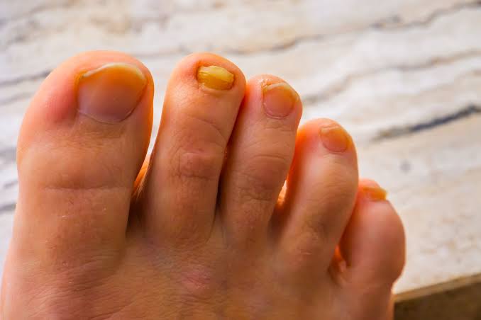 Why Do Toenails Turn Yellow? Causes and What to Do 2026