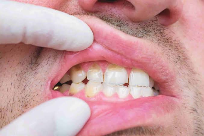 Why Does My Tooth Hurt When I Eat Sweets? What It Means 2026