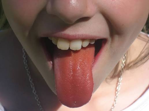 Why Is My Tongue Orange? Causes & When to Worry 2026