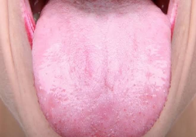 Why Are My Taste Buds Swollen? Causes & Fast Relief 2026
