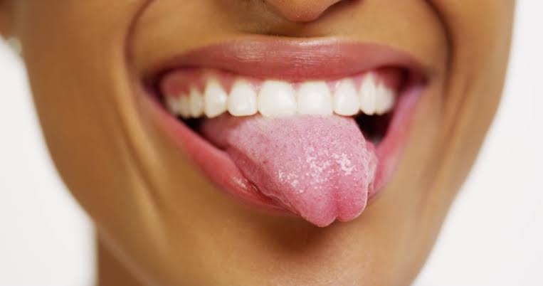 Why My Tongue White? Common Causes and Treatments 2026