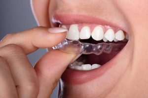 Fitting Clear Aligner Treatment Into A Fourteen Month Engagement