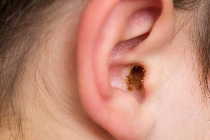 Why Is My Earwax Wet? Causes, Ear Wax Types, and When to Worry 2026