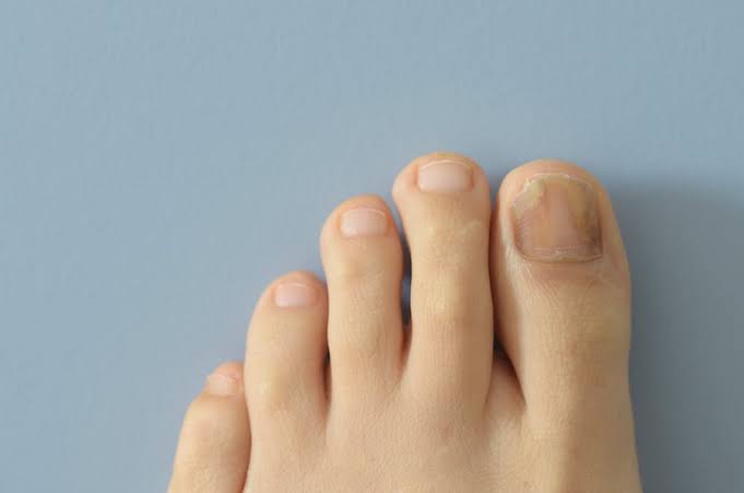 Why Do Toenails Turn Yellow? Causes and What to Do 2026