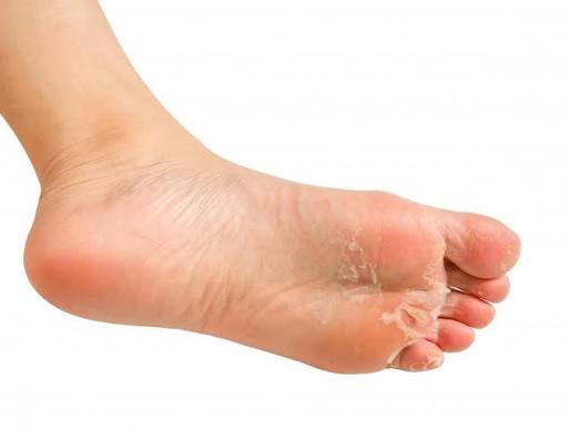 Why Are My Toes Peeling? Causes & Treatments 2026