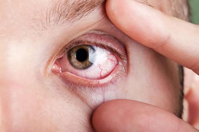 Why Does My Eyes Hurt? Causes & Relief Tips 2026