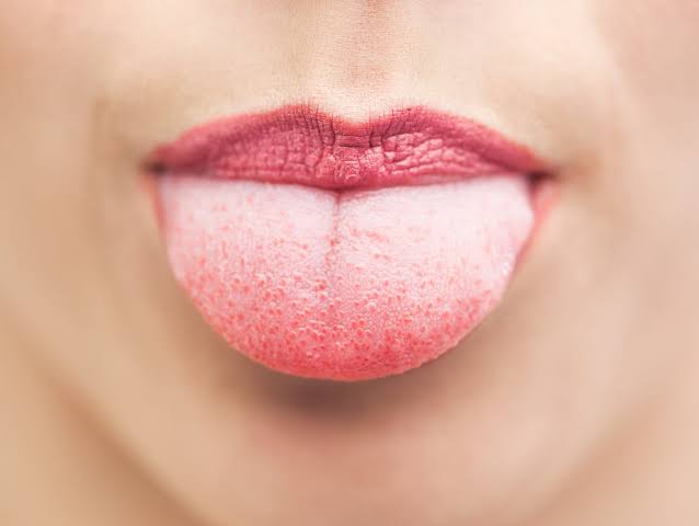 Why Are My Taste Buds Swollen? Causes & Fast Relief 2026