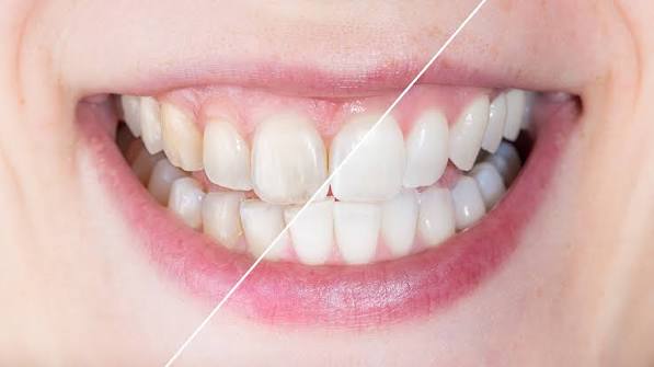 Why Does My Tooth Hurt When I Eat Sweets? What It Means 2026