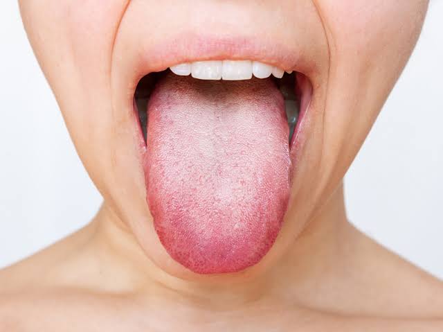 Why My Tongue White? Common Causes and Treatments 2026