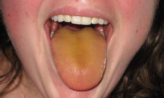 Why Is My Tongue Orange? Causes & When to Worry 2026
