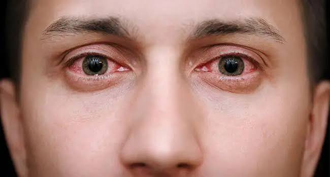 Why Is My Eye Burning? Causes & Fast Relief 2026