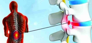 Why a Slipped Disc Doesn’t Always Mean You Need Surgery
